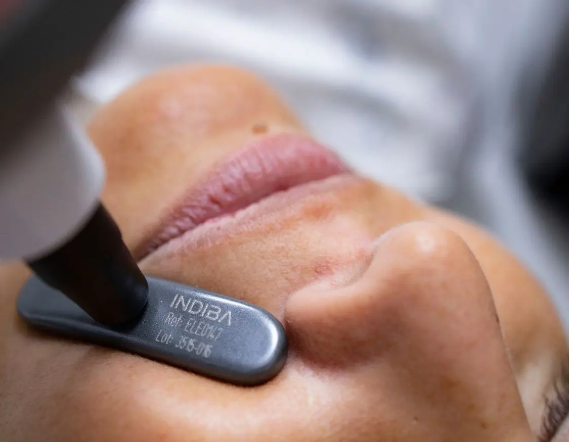 Persona recibiendo tratamiento estético facial con Indiba en la mejilla